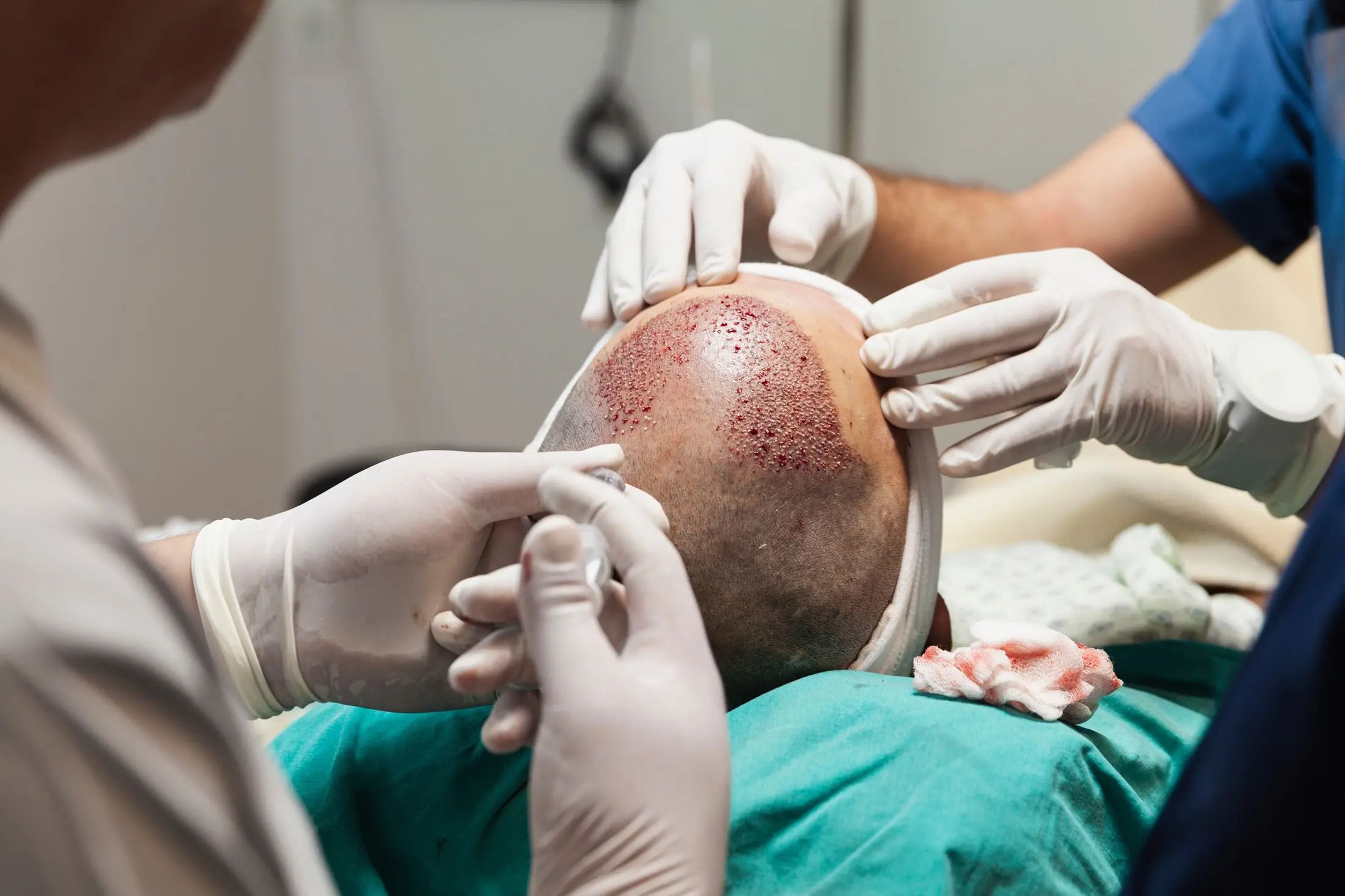 hair transplant surgery