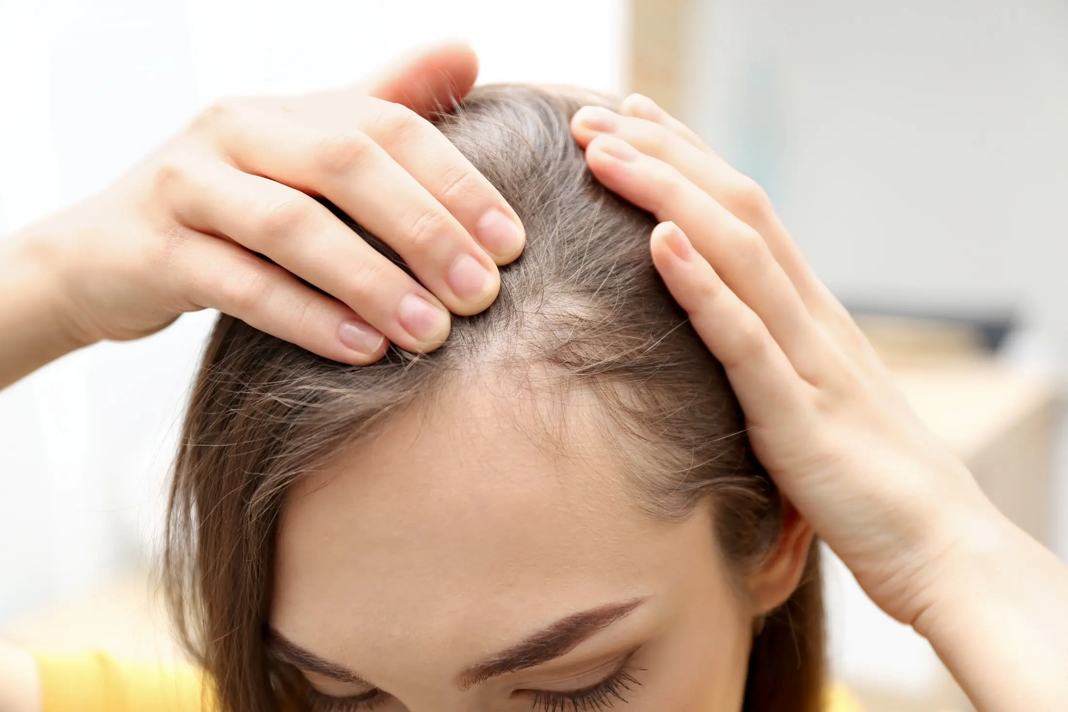 woman hairloss